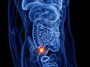 Vrsta raka koja je godinama bila retka sada sve češća među mladima – stručnjaci traže objašnjenje